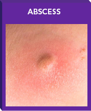 Trials Included ABSSSI Patients With Abscess