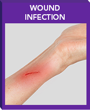 Trial Population Included ABSSSI Patients With Wound Infections