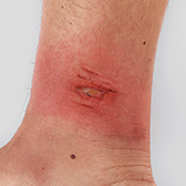 Skin Abrasion on the Right Ankle With Swelling and Tenderness